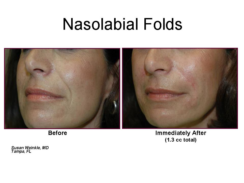 Nasolabial Folds